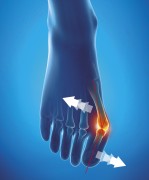 Orthèse corrective hallux valgus Nuit